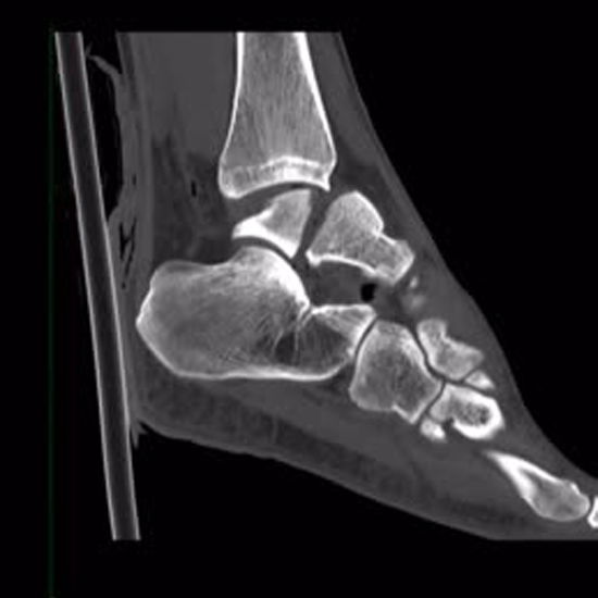 CECT Right Ankle Joint